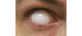 Blind lenses 03.png