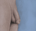 Penile implant in action.gif